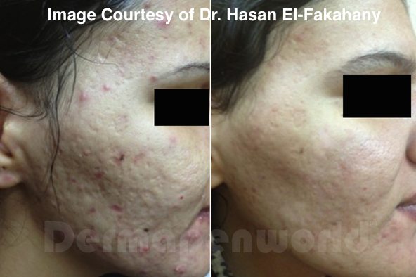 Acne Dr Hasan Fakahany Credited