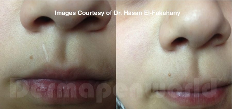 Lip Scar - Dr Hasan Fakahany