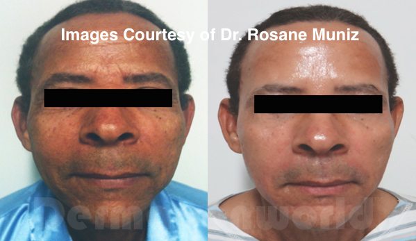 Rejuvenation Dr Rosane Muniz