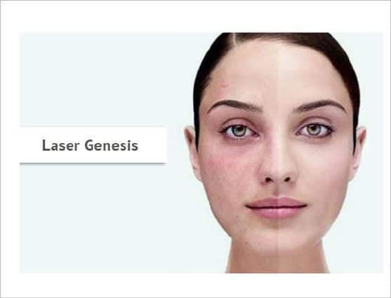 laser genesis
