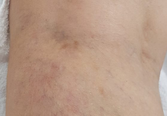 Leg vein After
