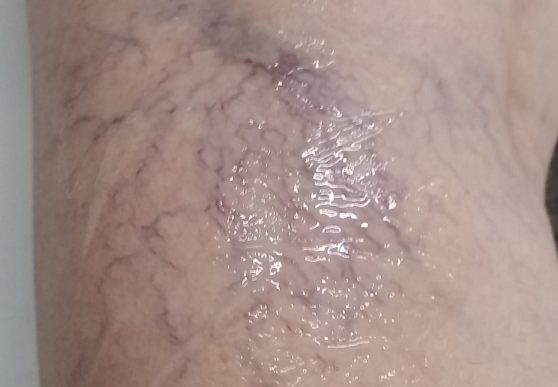 Leg vein Before